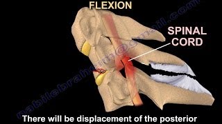 Tear Drop Fracture of the cervical spine  Everything You Need To Know  Dr Nabil Ebraheim [upl. by Stagg845]