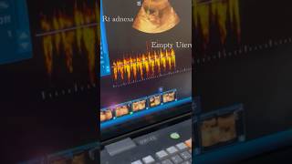 Unruptured Live Ectopic Pregnancy ectopicpregnancy ultrasonography [upl. by Aleyak]