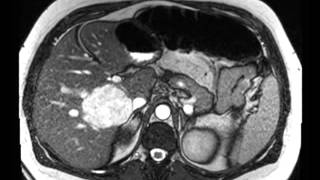 Liver Hemangioma [upl. by Reifinnej]