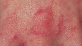 DO YOU HAVE SCABIES CLOSE LOOK AT THE SCABIES RASH [upl. by Aniluap]