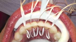 Retanium Splint Placement Orthodontics [upl. by Coe]