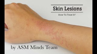 Skin lesions part 1Benign and Premalignant by ASM Minds Team [upl. by Hedvig]