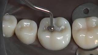 Class I Amalgam Preparation amp Restoration  Operative Dentistry [upl. by Myke]