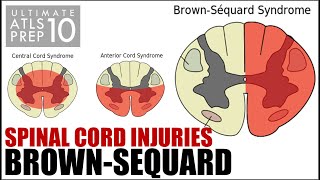 Ultimate ATLS 10 BrownSequard Syndrome  Spine amp Spinal Cord Trauma [upl. by Kallman]