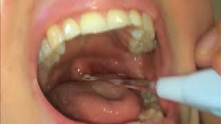 Tonsil Stones  How To Remove Them [upl. by Aoht]