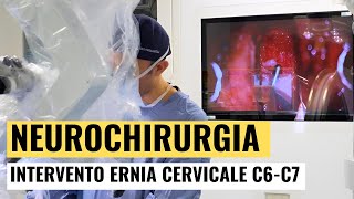 Neurochirurgia Ep 1  Un Caso di Ernia al Collo Foraminale C6C7 [upl. by Irneh]