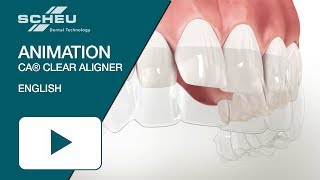 CA® CLEAR ALIGNER Animation english [upl. by Binetta]