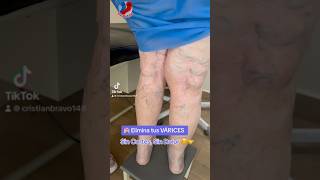 🏩 varices escleroterapia venasvaricosas venasvaricosas [upl. by Pembroke592]