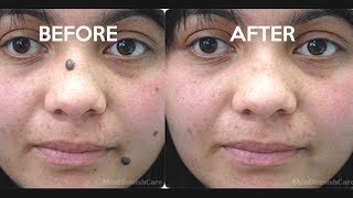 2 Easy Ways To Remove Moles From Your Face  How To Get Rid Of Moles [upl. by Glennie537]