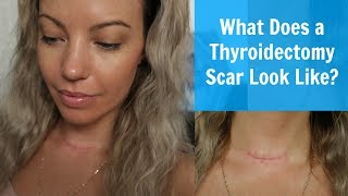 What Does A Thyroidectomy Scar Look Like [upl. by Nevlin]