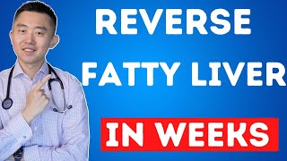 The FASTEST Way to Reverse Fatty Liver Naturally  NAFLD Treatment [upl. by Sibie]