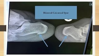 Bilateral Calcaneal Spur [upl. by Kohl]