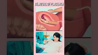 Removal of placenta fetalmovement bodypart baby cutebaby shorts [upl. by Ahsekyw]