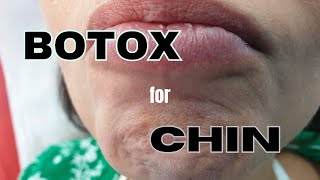 How to inject BOTOX on CHIN muscle Correcting peau dorange deformity with botulinum toxin [upl. by Liebowitz]