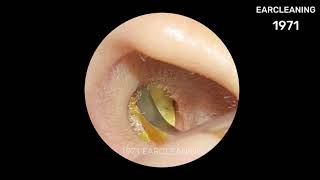 Earwax Cleaning  Earwax Removal ep42 [upl. by Iv]