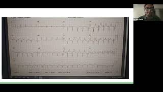 04 07 2024 Case Presentation Cirrhotic Patient for Right Hepatectomy [upl. by Hoxie984]