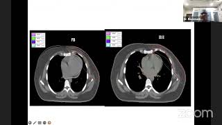 Dr V Ravi Shankar  Adjuvant Radiotherapy in Breast Cancer [upl. by Cassondra]