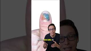 Hematoma Subungueal 💅😱 medicina medico curiosidades saude enfermeira enfermagem saúde [upl. by Nawoj]