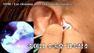 ASMR 중이염 수술후 10년만에 귀청소 놀라지 마세요 [upl. by Uhsoj223]