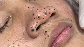 Big Cystic Acne Blackheads Extraction Blackheads amp Milia Whiteheads Removal Pimple Popping  6639 [upl. by Ariam]