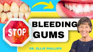 How To QUICKLY Treat Gingivitis and Bleeding Gums [upl. by Yelsehc446]