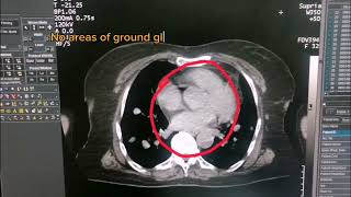 Nodules of Chest Part 02  Chest CT pathology  Thyroid Nodules  Chest CT with Contrast  Dr Green [upl. by Frankel]