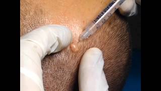 Removing mole with plasma pen [upl. by Ycniuqal]