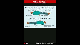 What Is Decerebrate PosturingShorts [upl. by Girand]