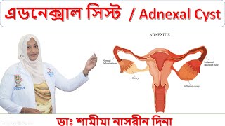 এডনেক্সাল সিস্ট । Adnexal Cyst । হোমিওপ্যাথিক চিকিৎসা। ডাঃ শামীমা নাসরীন দিনা । [upl. by Clothilde697]