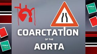 Coarctation of the aorta [upl. by Esinek283]