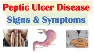 Peptic Ulcer Disease Signs amp Symptoms  Gastric vs Duodenal Ulcers [upl. by Nicki]