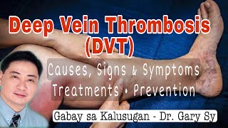 Deep Vein Thrombosis DVT  Dr Gary Sy [upl. by Berton]