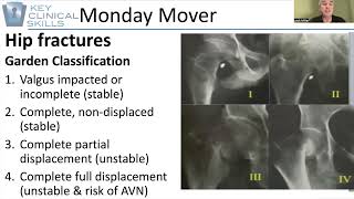 Hip Fractures and the impact on treatment [upl. by Rosco238]