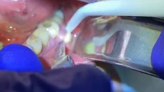 Draining a Dental Abscess  Advanced Dental Care [upl. by Ehtyaf]