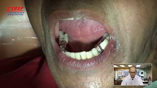 48Correção estética em dente metálico Veneer Dr Antônio Sérgio F Freitas [upl. by Raybourne]