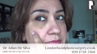 Blepharoplasty Video Diary Day 7 After Eyelid Surgery amp Recovery Process [upl. by Llydnek]