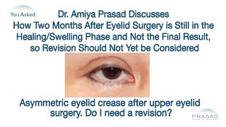 Why Two Months Post Surgery is Too Early to Gauge Final Results of Eyelid Procedures [upl. by Urian]