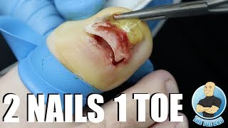 UNBELIEVABLE FUSED TOENAIL REMOVAL [upl. by Akcebar]