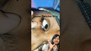 Wilson Disease  Kayser Fleischer Ring Pediatrics clincal case series [upl. by Caroline258]