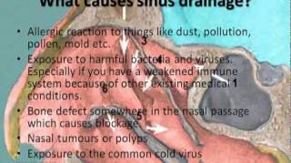 Sinus Drainage [upl. by Nyer390]