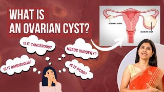 What is an Ovarian Cyst  Dr Anjali Kumar  Maitri [upl. by Aztinay]