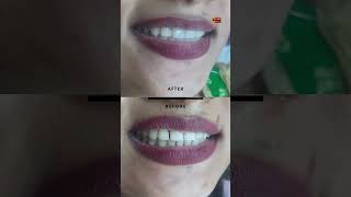 Teeth Gap Treatment shorts dranbudentist [upl. by Enhpad]