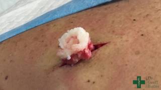 Removal of an Epidermal cyst on the upper back [upl. by Nelaf]