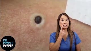 85 Year Old Blackhead Dr Pimple Popper Most Popular Pop of ALL TIME [upl. by Moreville67]