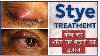 Easy Stye treatment at Home  Doctors tips for Stye Eye infection  कैसे करे आँख पर गुहरी का इलाज [upl. by Cheffetz]