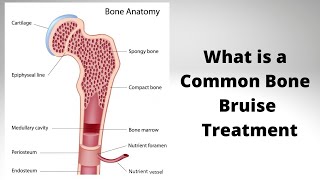 What is a Common Bone Bruise Treatment [upl. by Notnel293]