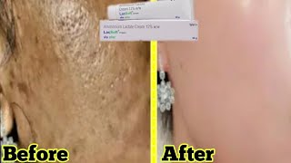 Lacsoft Cream  Remove Pigmentation  Dark spot  Acne amp Acne scars  Brijwasi Girl [upl. by Kirt108]