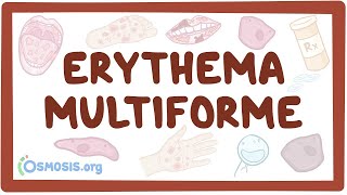 Erythema multiforme  causes symptoms diagnosis treatment pathology [upl. by Ninahs]