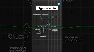 Hyperkalemia and Hypokalemia ECG changes [upl. by Ewall]