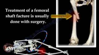 Fracture of the Femur and its fixation  Everything You Need To Know  Dr Nabil Ebraheim [upl. by Aenitsirhc]